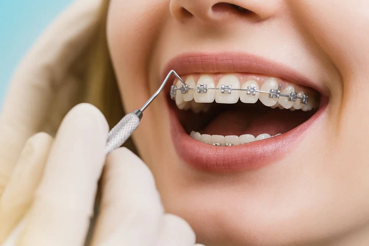 Профессиональная гигиена полости<br>рта для пациентов, проходящих ортодонтическое лечение, <br><span color-type="color" style="color: #617c9e;"><span style="font-weight: 700;">"Деликатное Сияние"</span></span><br>